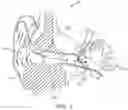 Fig. 02 - Optical electro-mechanical hearing devices with separate power and signal components