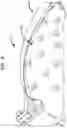 Fig. 16 - Hearing prosthesis accessory