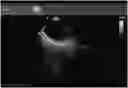Fig. 01 - COMPOSITIONS, METHODS AND SYSTEMS FOR IDENTIFYING THE POSITION AND ORIENTATION OF THE ESOPHAGUS IN ATRIAL FIBRILLATION ABLATION PROCEDURES
