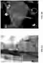 Fig. 07 - COMPOSITIONS, METHODS AND SYSTEMS FOR IDENTIFYING THE POSITION AND ORIENTATION OF THE ESOPHAGUS IN ATRIAL FIBRILLATION ABLATION PROCEDURES