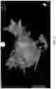 Fig. 08 - COMPOSITIONS, METHODS AND SYSTEMS FOR IDENTIFYING THE POSITION AND ORIENTATION OF THE ESOPHAGUS IN ATRIAL FIBRILLATION ABLATION PROCEDURES