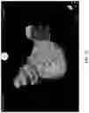 Fig. 10 - COMPOSITIONS, METHODS AND SYSTEMS FOR IDENTIFYING THE POSITION AND ORIENTATION OF THE ESOPHAGUS IN ATRIAL FIBRILLATION ABLATION PROCEDURES