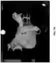 Fig. 11 - COMPOSITIONS, METHODS AND SYSTEMS FOR IDENTIFYING THE POSITION AND ORIENTATION OF THE ESOPHAGUS IN ATRIAL FIBRILLATION ABLATION PROCEDURES