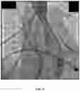 Fig. 12 - COMPOSITIONS, METHODS AND SYSTEMS FOR IDENTIFYING THE POSITION AND ORIENTATION OF THE ESOPHAGUS IN ATRIAL FIBRILLATION ABLATION PROCEDURES