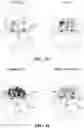 Fig. 22 - Utilizing correlations between PPG signals and iPPG signals to improve detection of physiological responses