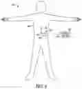 Fig. 04 - Stimulation progamming aid using a sensory projection