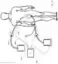 Fig. 30 - SYSTEMS, DEVICES AND METHODS FOR SENSING PHYSIOLOGIC DATA AND DRAINING AND ANALYZING BODILY FLUIDS