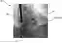 Fig. 01 - Device and a corresponding method for providing spatial information of an interventional device in a live 2D X-ray image