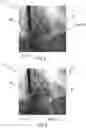 Fig. 05 - Device and a corresponding method for providing spatial information of an interventional device in a live 2D X-ray image