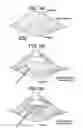 Fig. 09 - METHOD AND DEVICES FOR A SUB-SPLENIUS/SUPRA-LEVATOR SCAPULAE SURGICAL ACCESS TECHNIQUE
