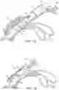 Fig. 02 - Multi-suture knotless anchor for attaching tissue to bone and related method