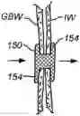 Fig. 01 - Tissue anchor for securing tissue layers