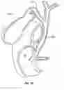 Fig. 07 - Tissue anchor for securing tissue layers