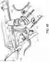 Fig. 94 - METHOD OF APPLYING AN ANNULAR ARRAY OF STAPLES TO TISSUE