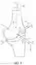Fig. 04 - Tibial cut guide