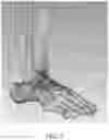 Fig. 02 - Patient-specific template for total ankle replacement