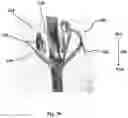 Fig. 10 - Devices for the removal of clots
