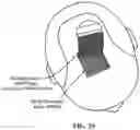 Fig. 38 - Pixel array medical systems, devices and methods