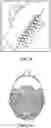 Fig. 41 - Pixel array medical systems, devices and methods