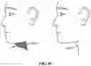 Fig. 85 - Pixel array medical systems, devices and methods