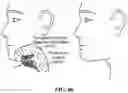 Fig. 86 - Pixel array medical systems, devices and methods