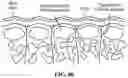 Fig. 88 - Pixel array medical systems, devices and methods