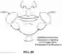 Fig. 89 - Pixel array medical systems, devices and methods