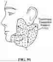 Fig. 91 - Pixel array medical systems, devices and methods