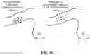 Fig. 94 - Pixel array medical systems, devices and methods