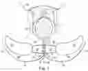 Fig. 03 - Method of securing perianal support device