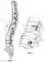 Fig. 02 - Spinal correction system and method of use thereof