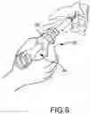 Fig. 06 - Vertebral joint implants and delivery tools