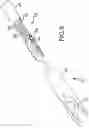 Fig. 11 - Vertebral joint implants and delivery tools