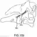 Fig. 132 - Vertebral joint implants and delivery tools