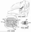 Fig. 133 - Vertebral joint implants and delivery tools