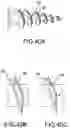 Fig. 30 - Vertebral joint implants and delivery tools