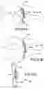 Fig. 52 - Vertebral joint implants and delivery tools