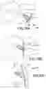 Fig. 69 - Vertebral joint implants and delivery tools