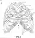 Fig. 02 - Adjustable rib and sternal implant
