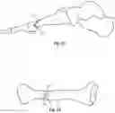 Fig. 17 - Orthopedic bone screw