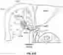 Fig. 137 - Heated vapor ablation systems and methods for treating cardiac conditions