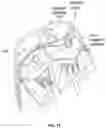 Fig. 33 - Heated vapor ablation systems and methods for treating cardiac conditions
