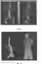 Fig. 09 - Spinal implant system and methods of use