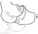 Fig. 03 - Kinematically aligned robotic total knee arthroplasty