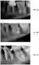 Fig. 37 - Endodontic instruments and root canal treatment methods