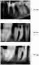 Fig. 38 - Endodontic instruments and root canal treatment methods