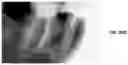 Fig. 41 - Endodontic instruments and root canal treatment methods