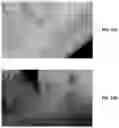 Fig. 44 - Endodontic instruments and root canal treatment methods