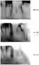 Fig. 46 - Endodontic instruments and root canal treatment methods