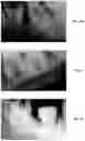Fig. 47 - Endodontic instruments and root canal treatment methods